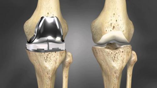 Резидент «Сколково» запустил первое в России производство протезов колена.